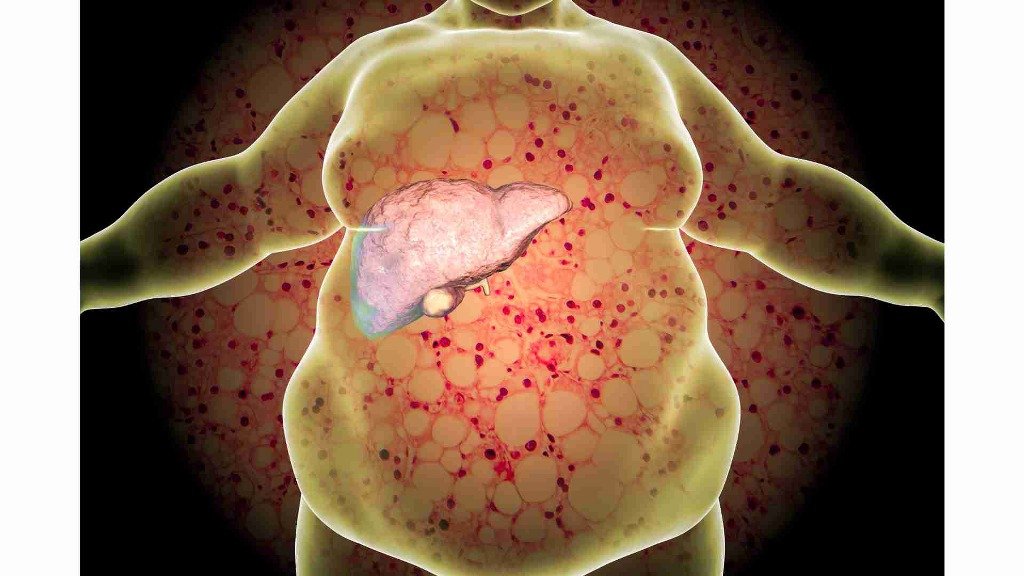 Comorbidities of Obesity and Its Impact on Health