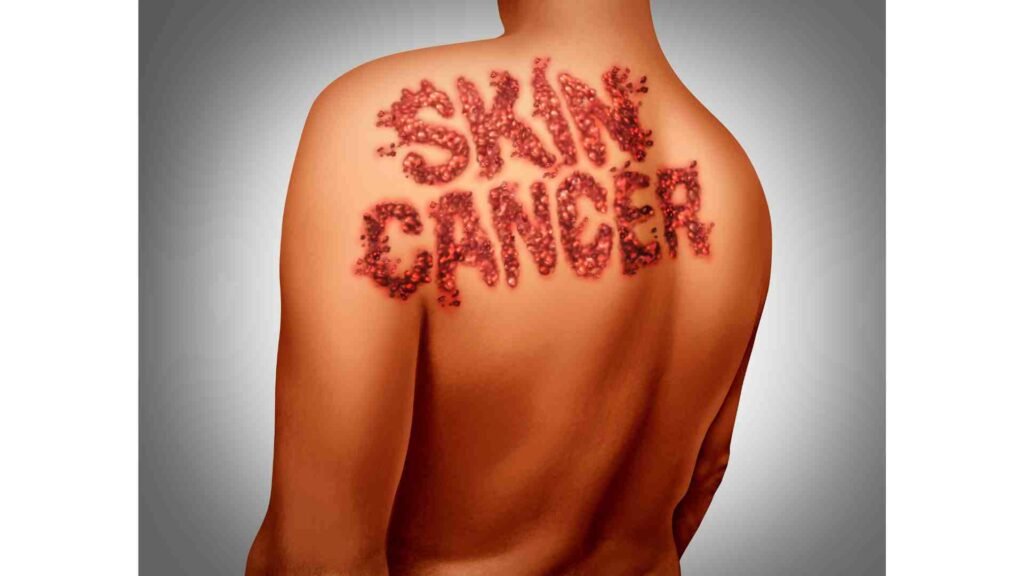 Will skin cancer kill you